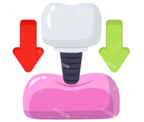 種植牙的用力示意圖 種植牙的用力示意圖