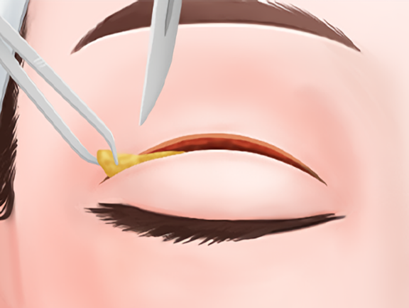 南昌簡雪平雙眼皮手術基本情況