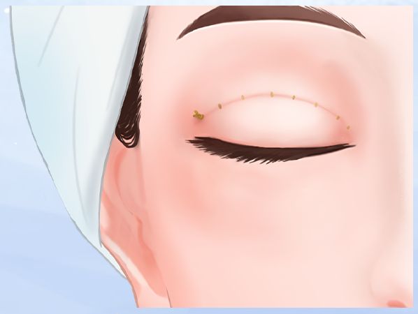 南昌簡雪平雙眼皮能否面診當天做