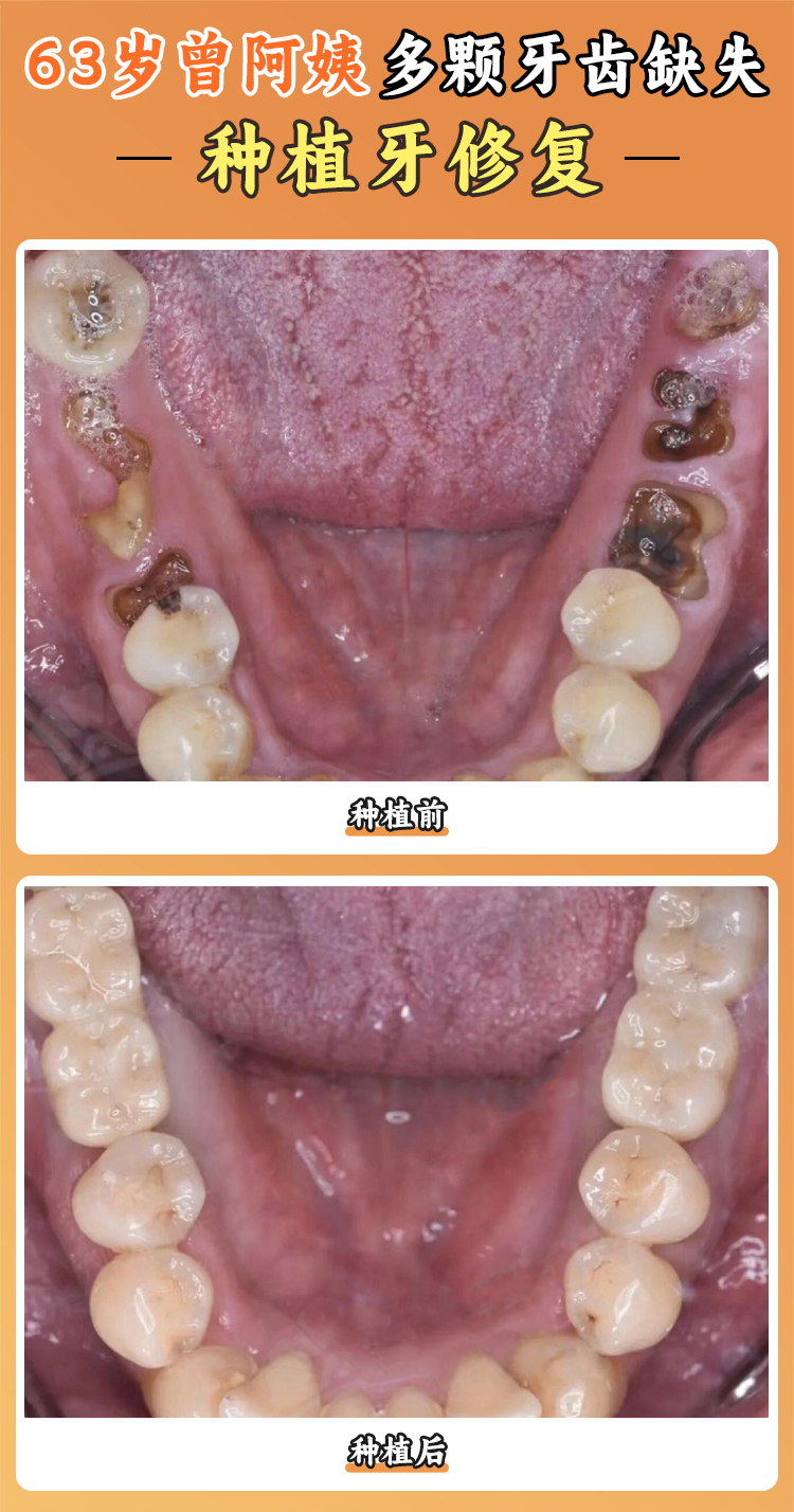 杭州排名前十口腔醫(yī)院：做種植牙價(jià)格實(shí)惠的就屬這五家性價(jià)比高