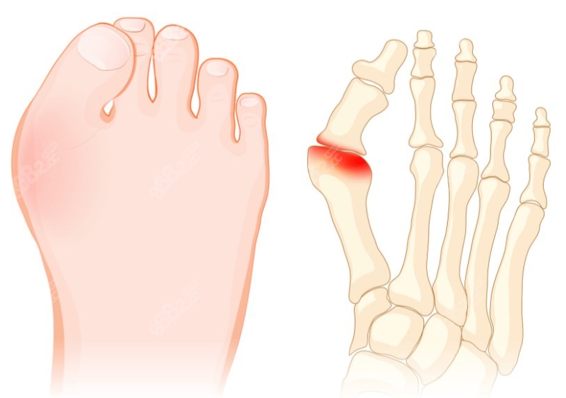 官網(wǎng)渠道！北京拇指外翻蘇敬達醫(yī)生怎么預約？圣嘉新4009998737一鍵預約