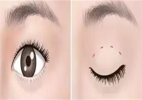 南京金東勛雙眼皮案例效果如何？恢復(fù)快、個性化定制，多案例見證神奇蛻變！