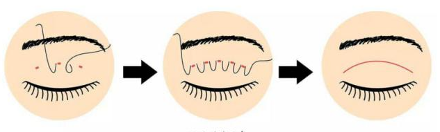 李紹思浮橋雙眼皮是什么意思？