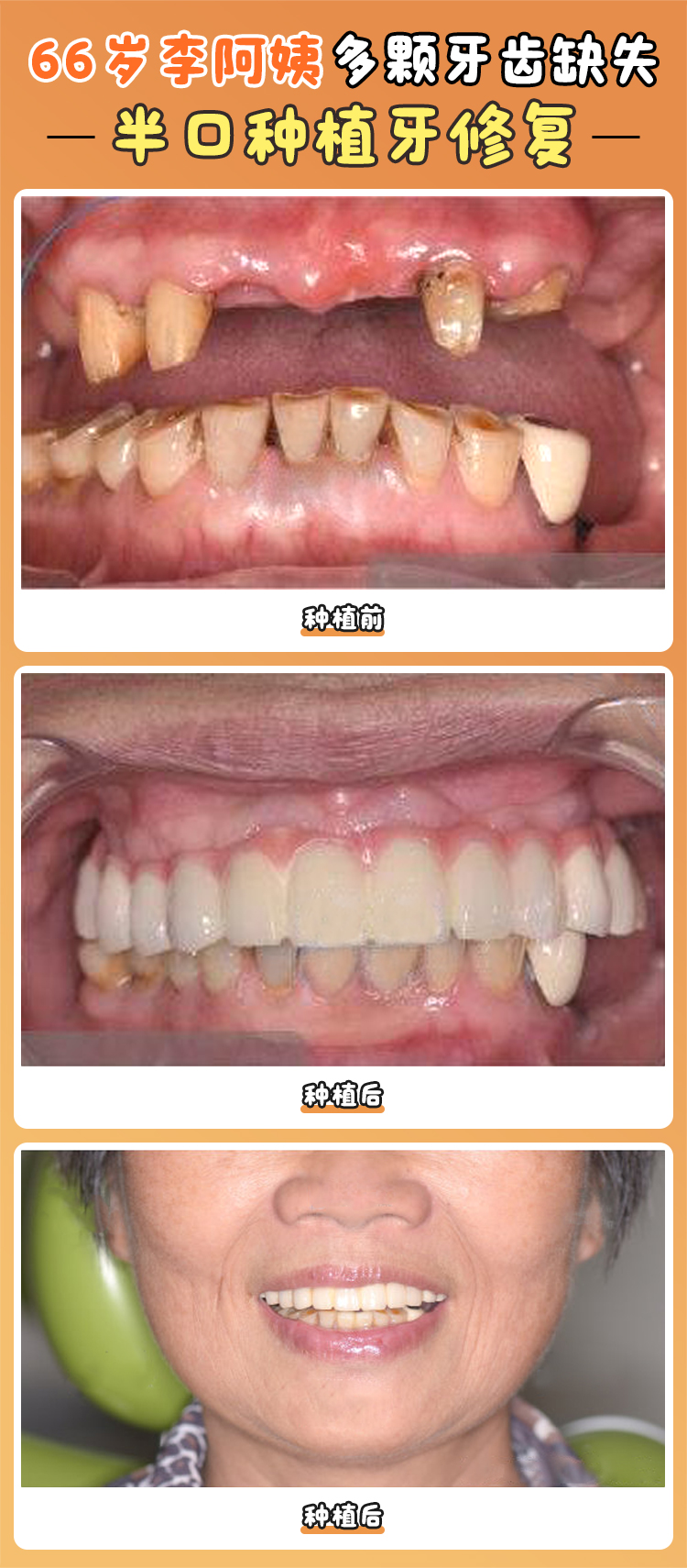 三、成都市新橋口腔醫(yī)院種植牙的獨(dú)特優(yōu)勢