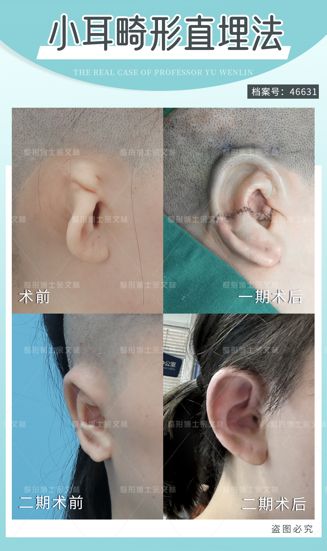 耳再造技術(shù)價(jià)格詳解www.sorencai.cn