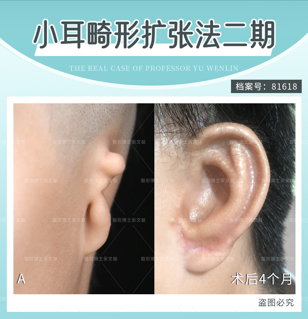 總結(jié)：選擇張?zhí)煊钺t(yī)生，耳再造更有保護(hù)