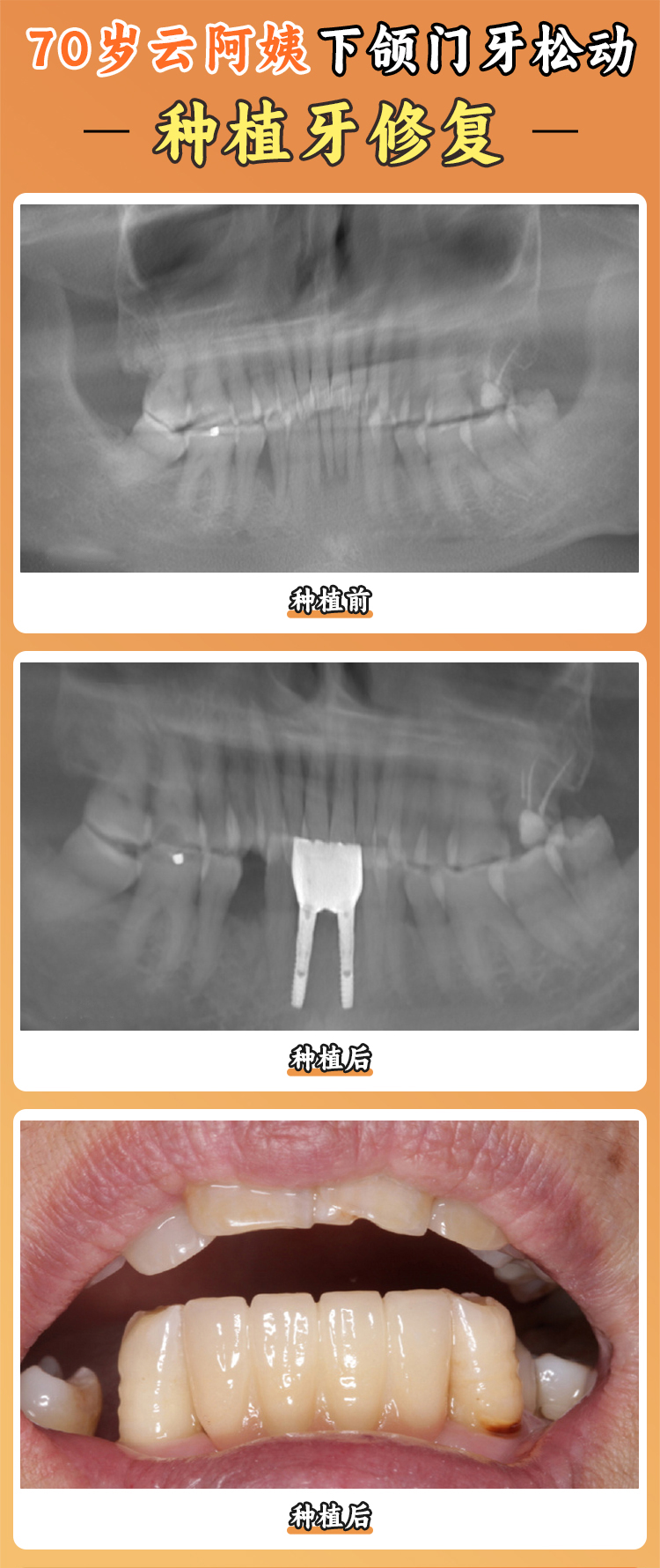 二、深圳穗華口腔多品牌種植牙價(jià)格參考www.sorencai.cn