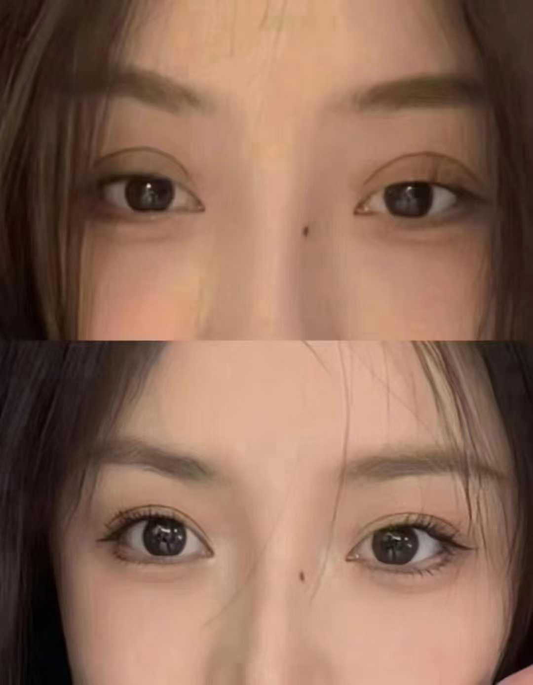 選擇王恒和李燕醫(yī)生做雙眼皮修復(fù)的優(yōu)勢(shì)總結(jié)