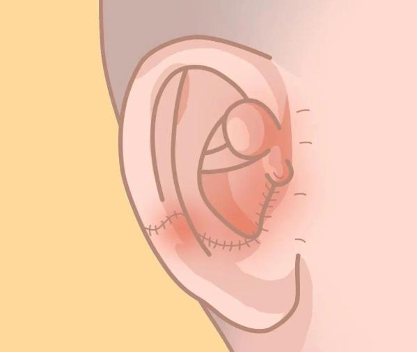 一、張?zhí)煊詈凸鶚渲艺l做耳再造膩害
