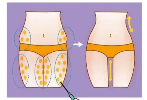 1、三人抽脂各有側重，核心差異在哪？避開選擇雷區(qū)