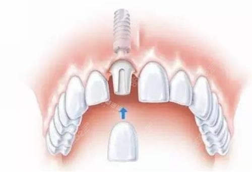 種植牙的種植部位