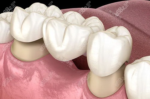 全瓷牙冠鑲牙示意圖