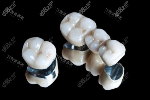 烤瓷牙冠模型圖