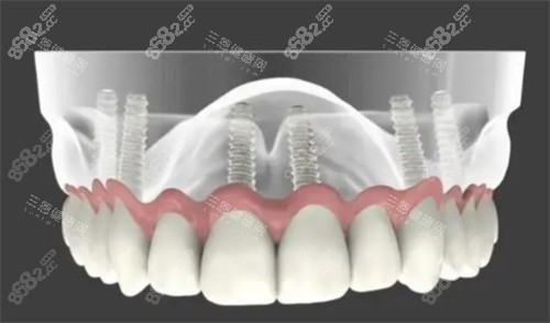 全口種植牙解析圖 全口種植牙解析圖