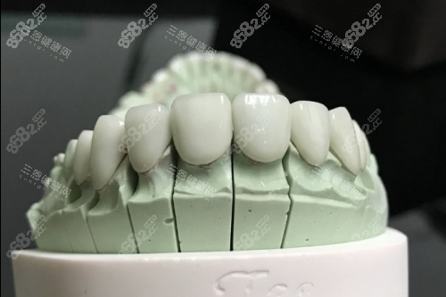 全瓷牙模型展示圖