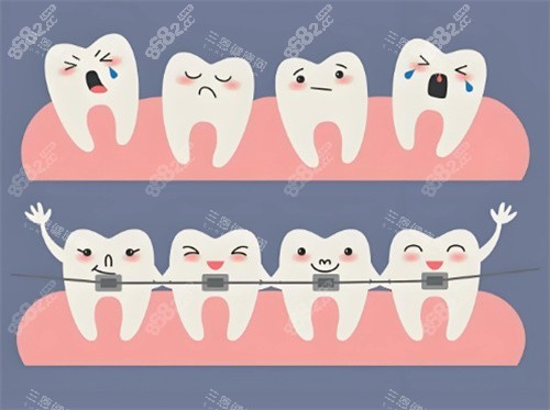牙齒矯正卡通展示
