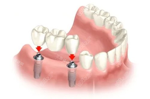 種植牙冠安裝示意圖