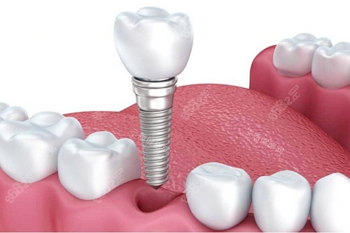 種植牙植入圖