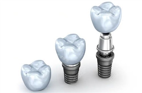 種植牙基臺牙冠