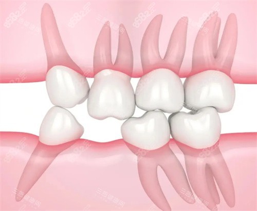 牙齒拔牙治療圖片 牙齒拔牙治療圖片