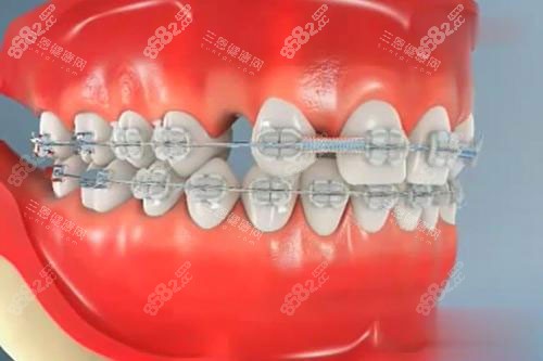 牙齒矯正模型漫畫