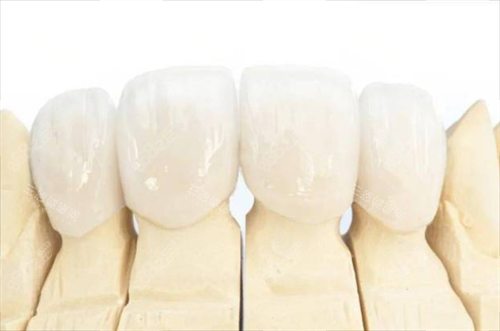 全瓷牙冠佩戴模型展示