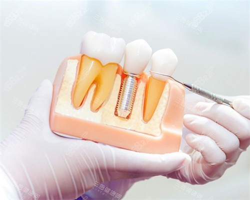 單顆種植牙模型