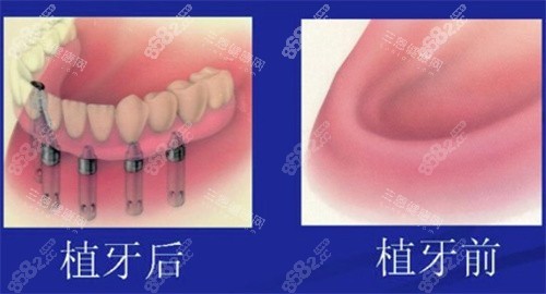 全口種植牙前后 全口種植牙前后