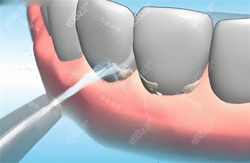 洗牙動畫展示圖片
