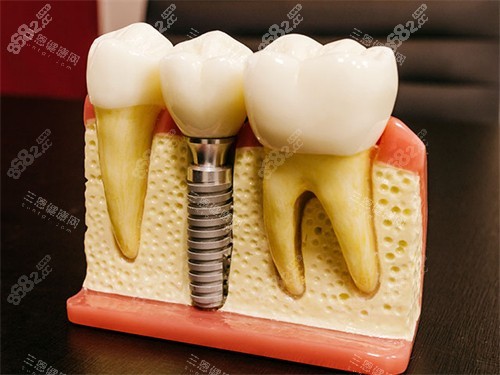 種植牙模型圖
