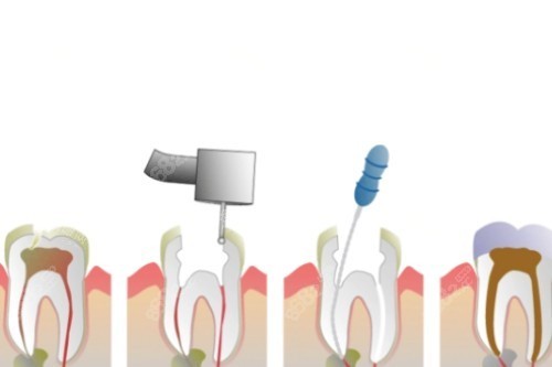 根管治療步驟一覽圖