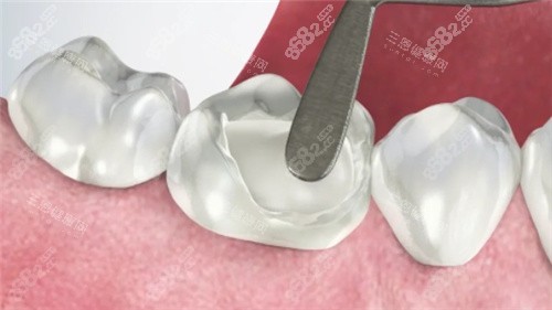 烤瓷牙素材圖