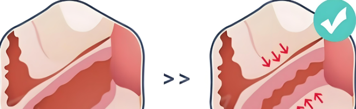 鱷魚圈緊縮術是什么？原理與核心優(yōu)勢