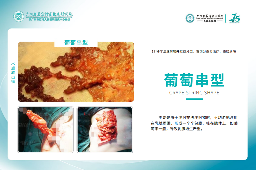 奧美定取出避坑指南（別只看價格）