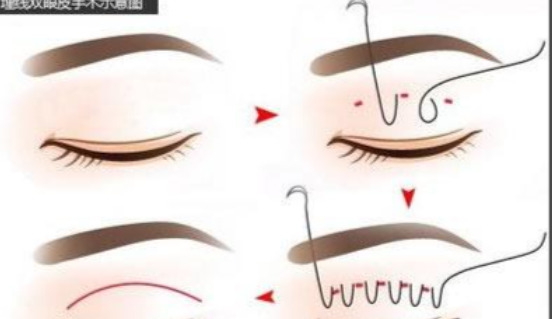 一、上海呂成雙眼皮手術(shù)價(jià)格表價(jià)格明細(xì)