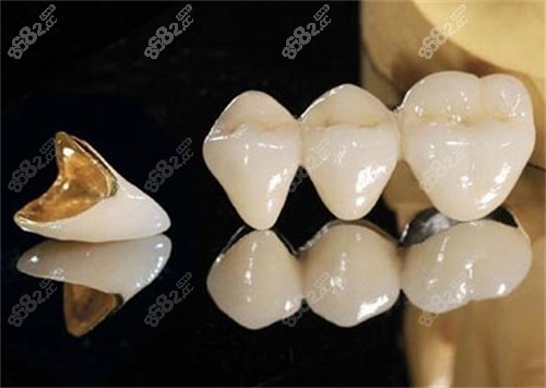 單顆烤瓷牙和連冠烤瓷牙