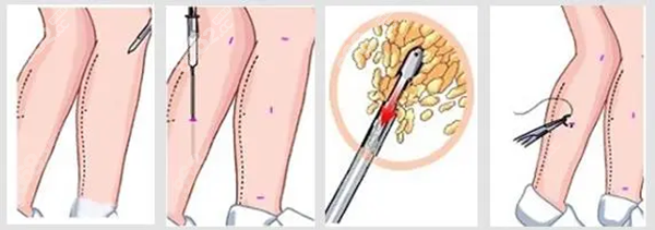 馮斌北京吸脂醫(yī)生簡介一覽表