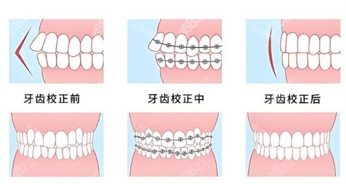 牙齒矯正前后對(duì)比圖