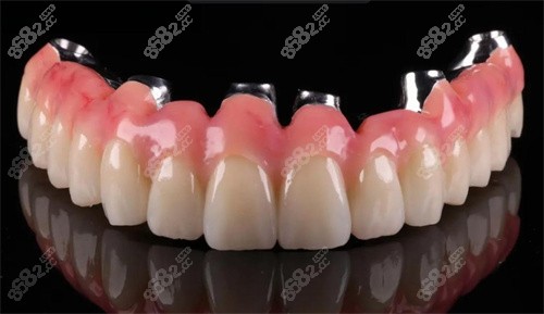 馬龍橋種植牙技術