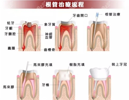 根管治療流程