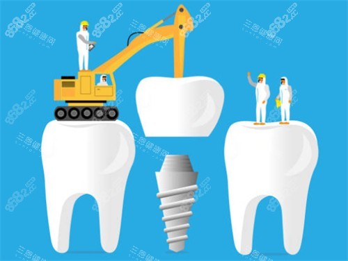 種植牙工程示意圖