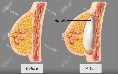 假體隆胸植入的層次
