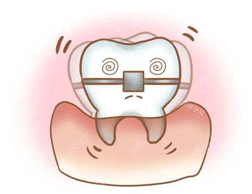牙齒矯正松動(dòng).webp