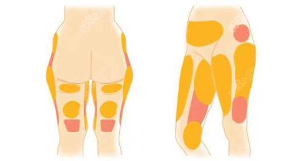 花了20萬找馮斌吸脂是真的很值不會(huì)反彈