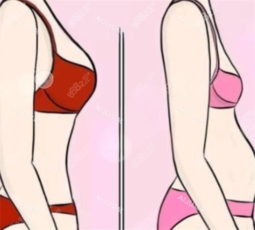 隆胸前后成效對(duì)比圖 隆胸前后成效對(duì)比圖