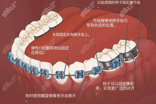 金屬牙齒矯正器功能示意圖