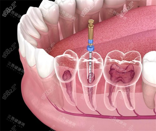 根管治療修復壞牙
