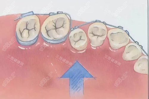 牙齒矯正示意圖