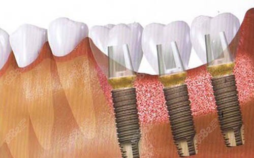 種植牙手術后圖