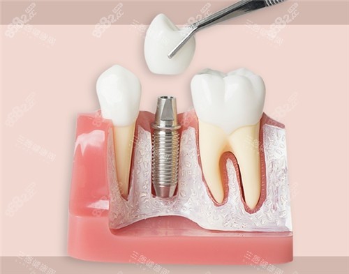 種植牙模具圖片